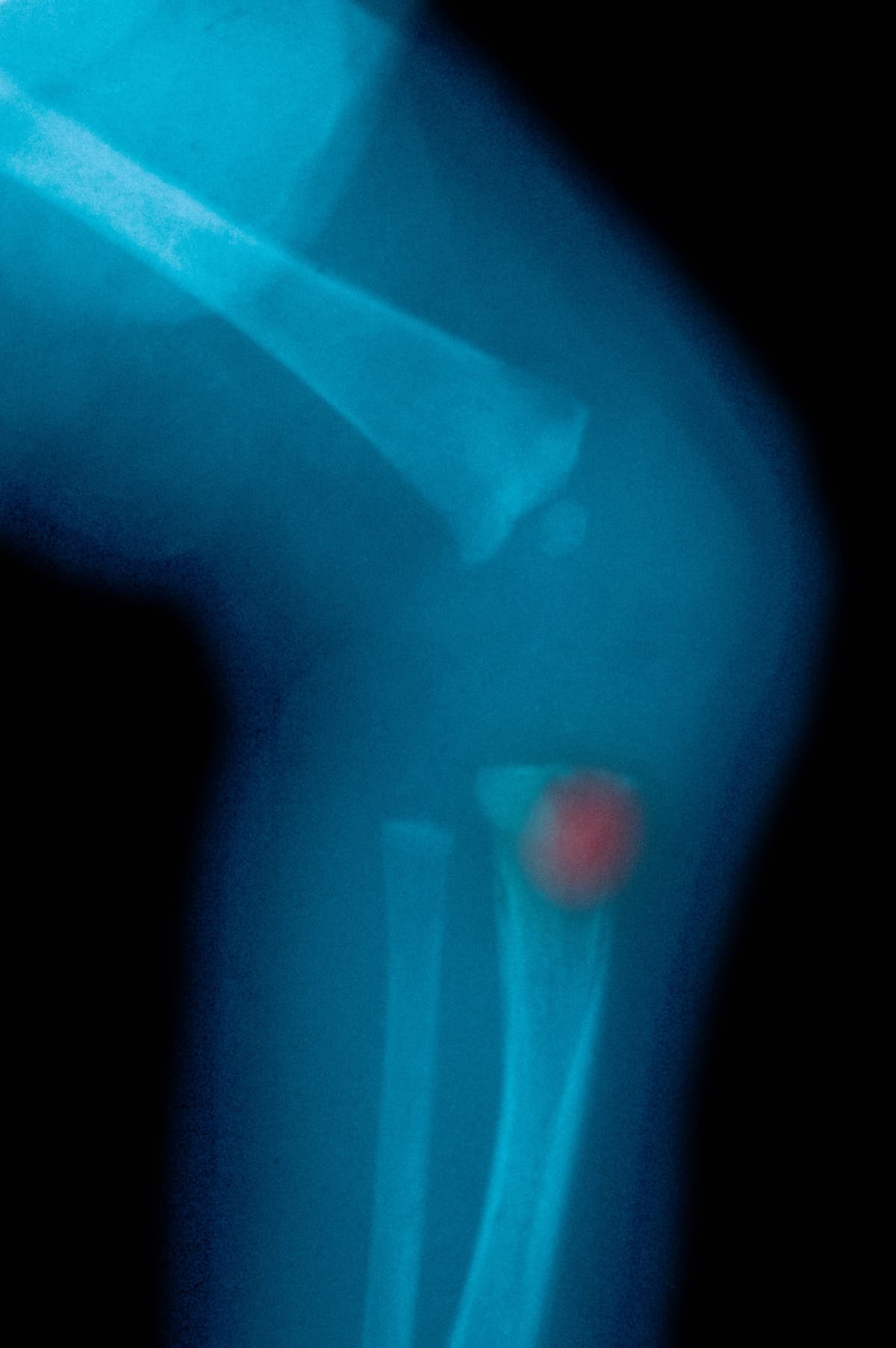 (Callista Images) Congenital syphilis: knee xray of newborn, stock photo.